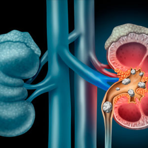Cálculo Renal Cálculo Renal