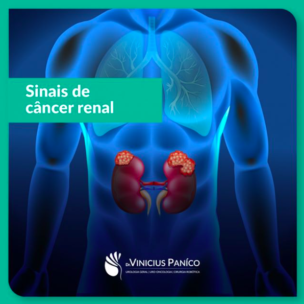 Sinais de câncer renal: Entenda quais são Sinais de câncer renal: Entenda quais são