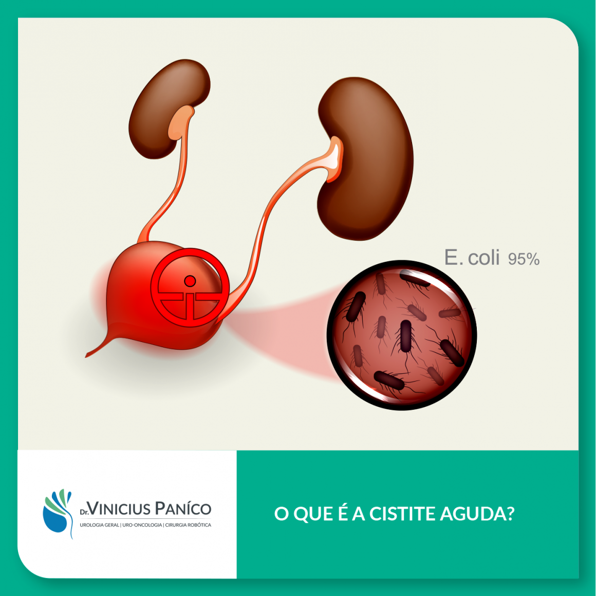 O que é a cistite aguda? O que é a cistite aguda?